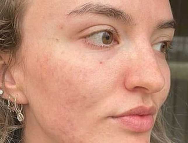 dermalux-acne-after-1