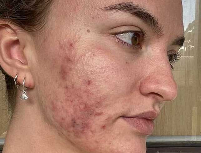 dermalux-acne-before-1