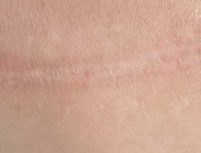 rf-microneedling-after-2