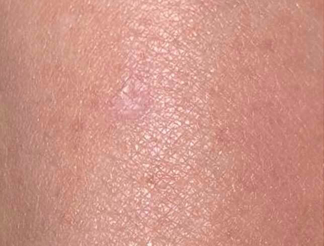 skin-tag-after2